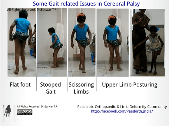 Gait Problems in Cerebral palsy