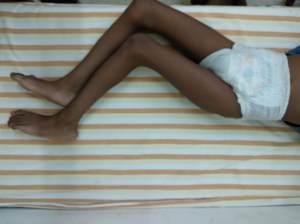 cerebral palsy child with dislocated hips