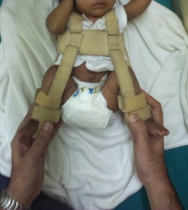 Pavlik Harness for DDH hip needs to be fitted properly