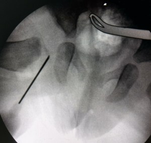 Arthrogram for DDH