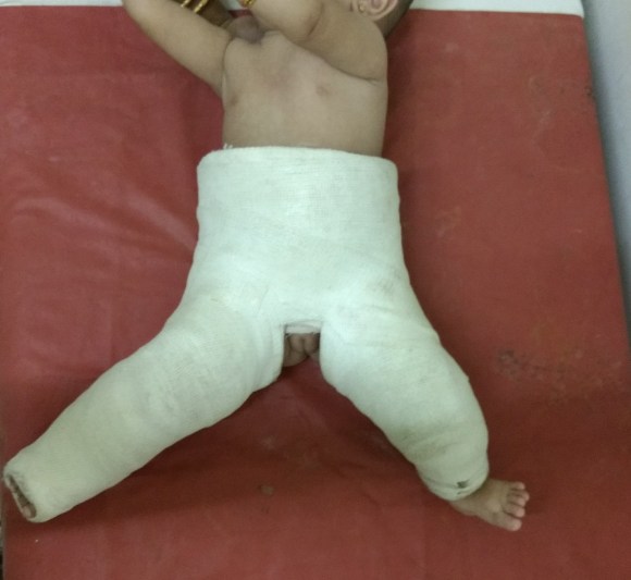 Hip Spica Plaster in child with DDH