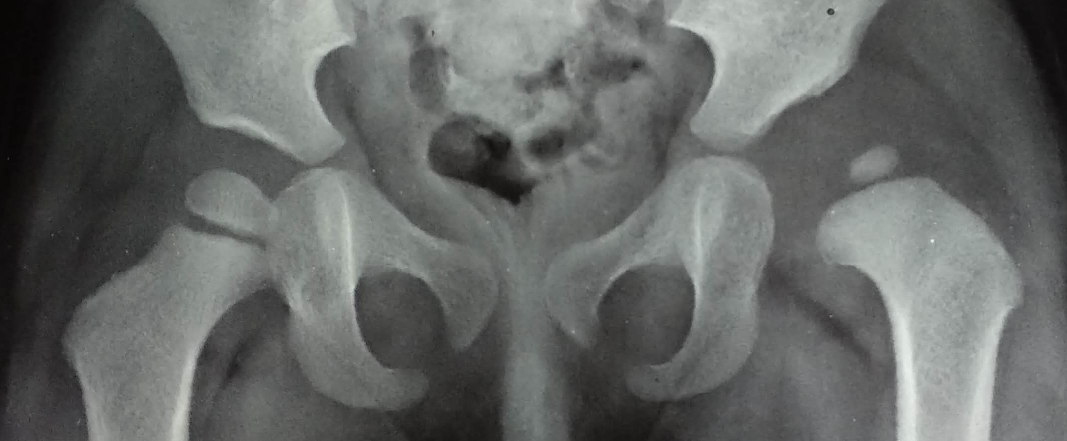 Developmental Dysplasia of Hip - Left hip is dislocated