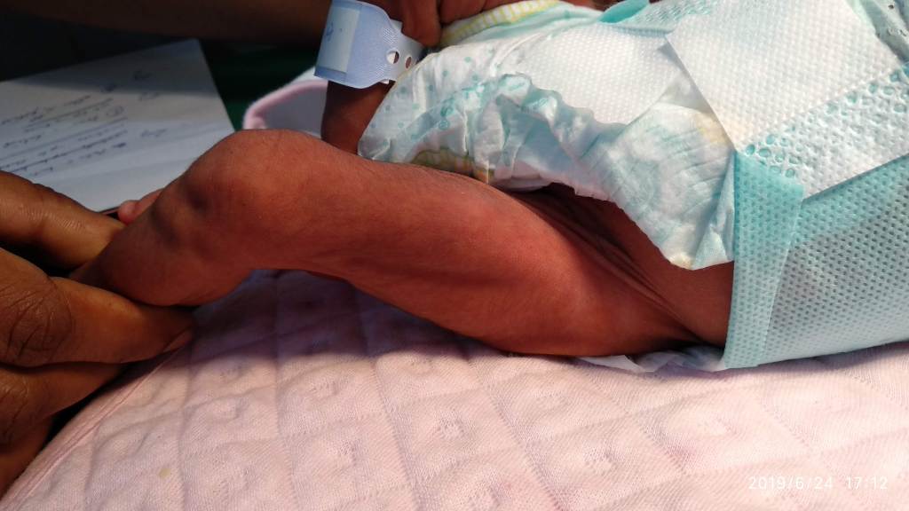 Infected Swelling in the Thigh