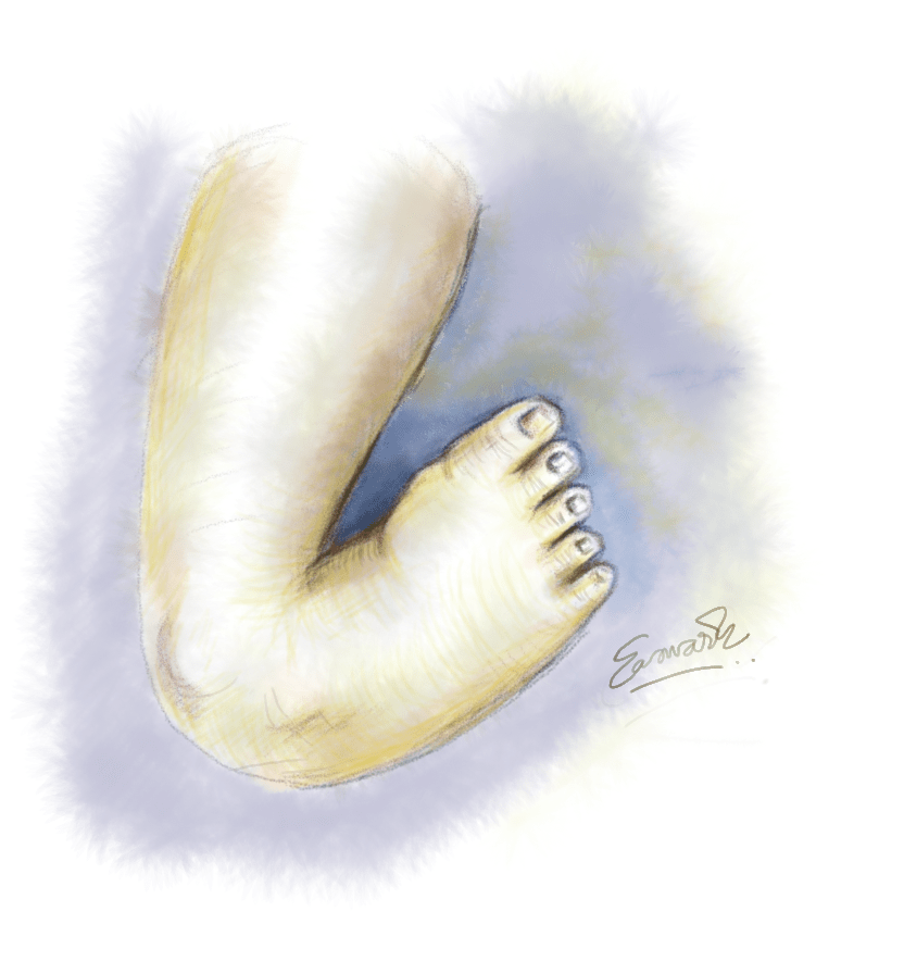 Clubfoot #Art for my upcoming project among #Clubfoot #children in #Kerala #DigitalArt @wacom one tablet @childortho @GlobalClubfoot