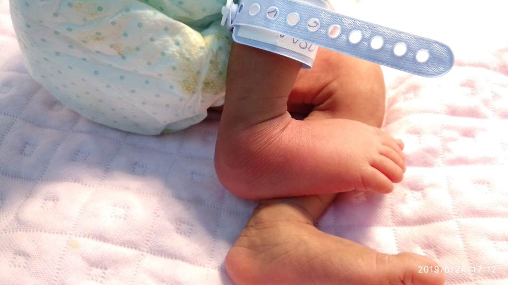 Heel Bone Calcaneal Osteomyelitis in New Born Child