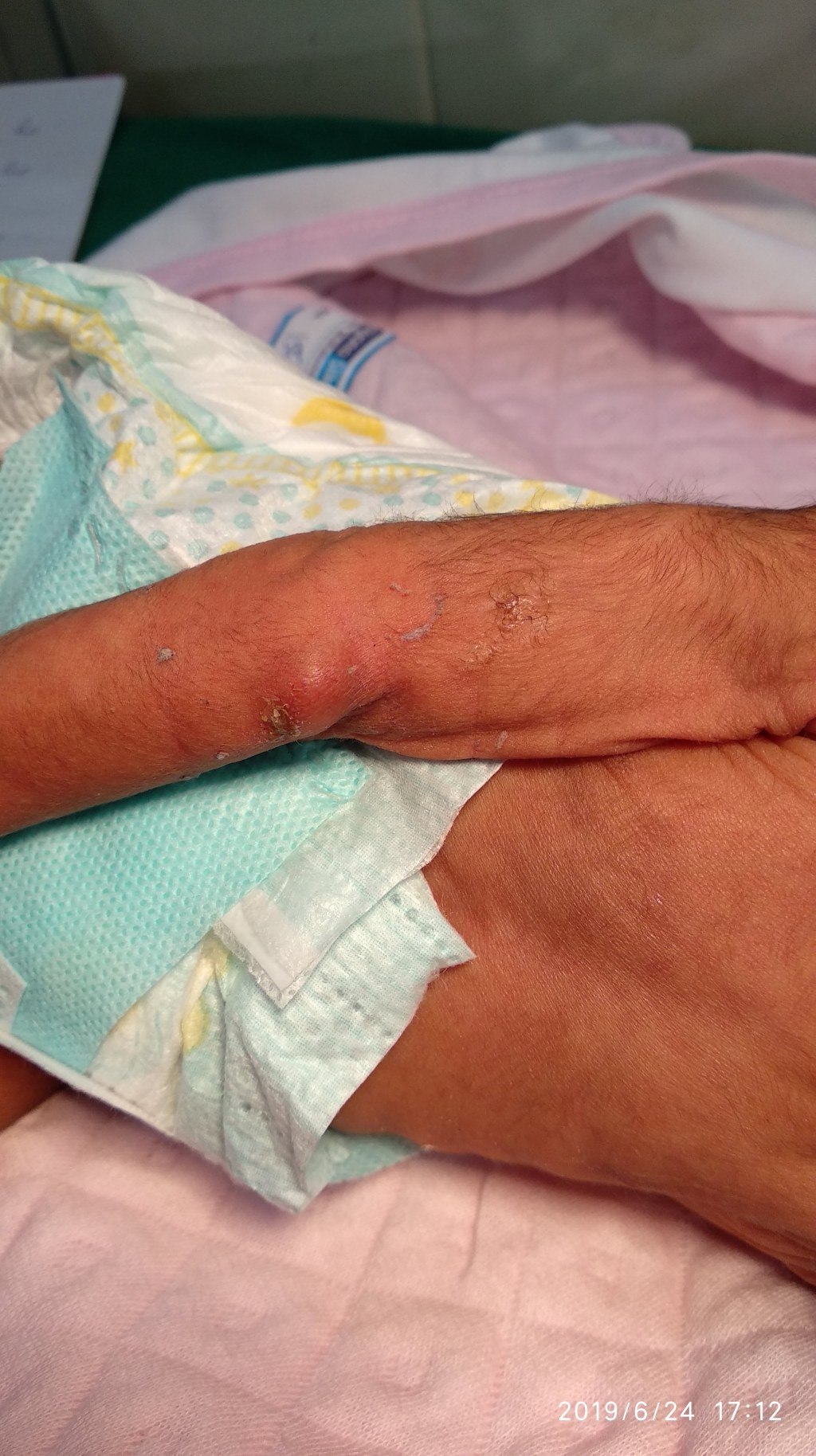 Infected Swelling in the elbow - Possible Septic Arthritis in Newborn child