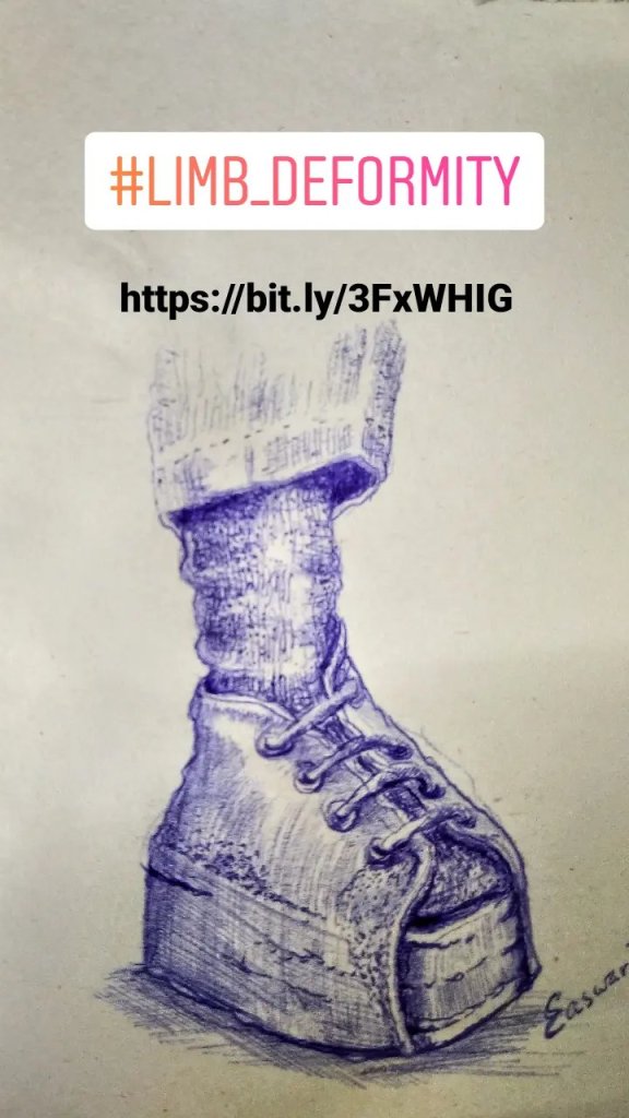 fibular-hemimelia-art