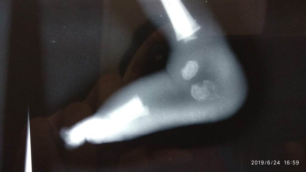 Destroyed Calcaneum in Newborn child